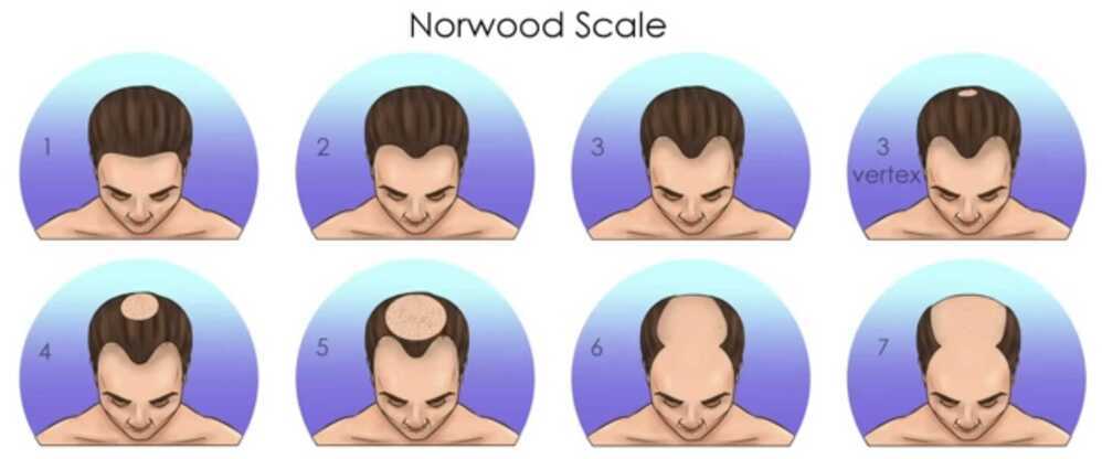 Norwood scale